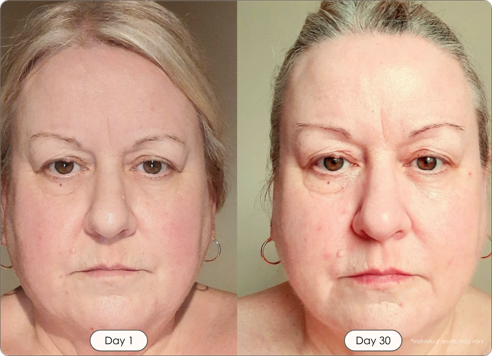 Lumamask Pro LED infrared light therapy before and after results showing reduced fine lines and smoother skin after 30 days