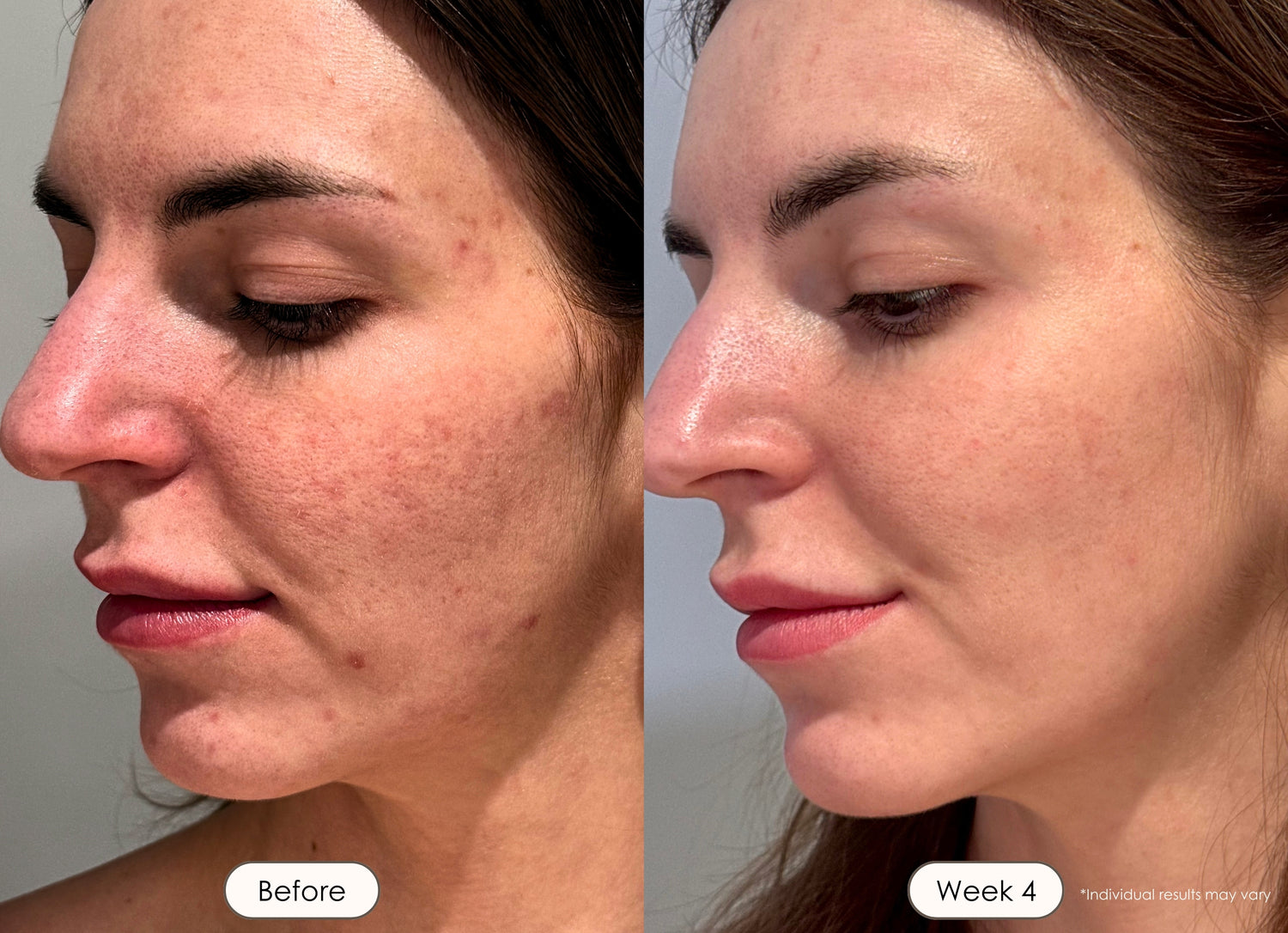 Visible skin improvement after LED light therapy treatment in 4 weeks.