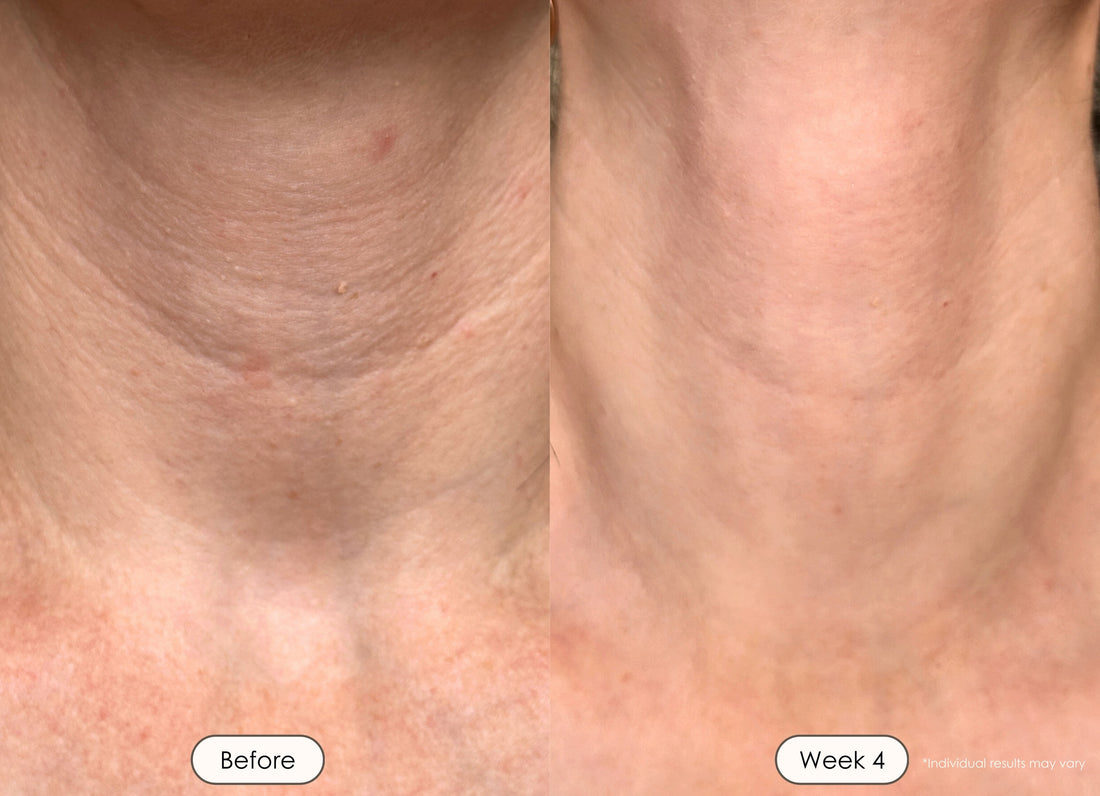 visible results after 4 weeks of using the LED light therapy face and neck mask